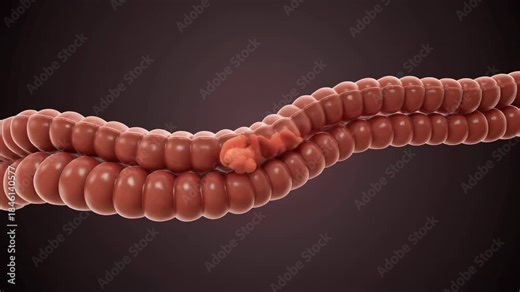 Intestinal Intussusception Medical Animation Depicting Bowel Obstruction and Telescoping of the Gut Anatomy