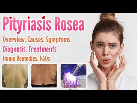 Pityriasis Rosea Overview, Causes, Signs and Symptoms, Diagnosis, Treatment, Home Remedies, and FAQs