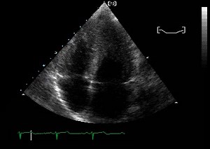 20 reactions | Apical 4-chamber echocardiogram in a patient with the apical variant of hypertrophic cardiomyopathy (HCM) Apical four-chamber view from a two-dimensional echocardiogram shows apical and midventricular hypertrophy. During systole, the left ventricular cavity is nearly obliterated. | Cardiovascular Education | Facebook