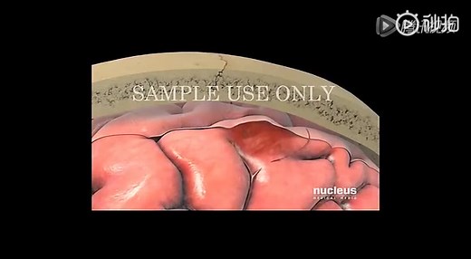 3D医学动画：《了解脑溢血》