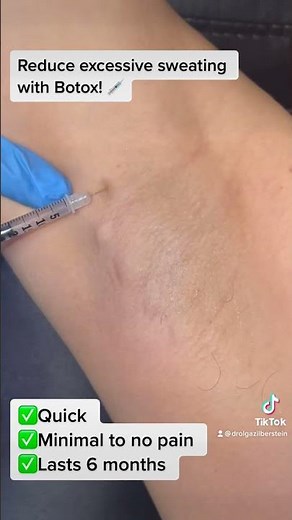 Botox Treatment For Hyperhidrosis!