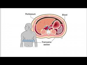 Hemoperitoneum (Blood in the Peritoneum); Definition, Causes, Symptoms and Treatment