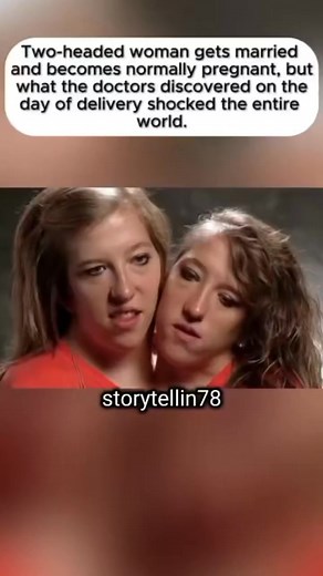 “Two-Headed Woman Marries and Becomes Pregnant—What Doctors Saw on Delivery Day Shocked the World” | storytellin78