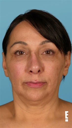 Renee's nose is about to pop off her face?! #botched #shorts #nosejobs