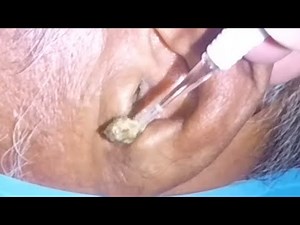 Elderly Man's Earwax Removal done Fast & Easy