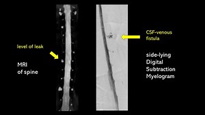 Jeff's spinal CSF leak story - Spinal CSF Leak Foundation