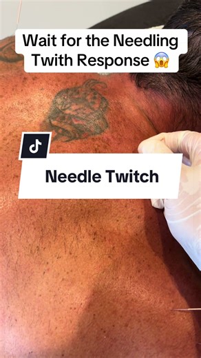 Experience the Benefits of Deep Tissue Needling Massage