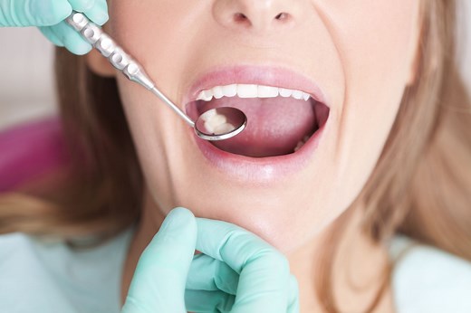 All About Cavities Between Teeth and How to Treat Them
