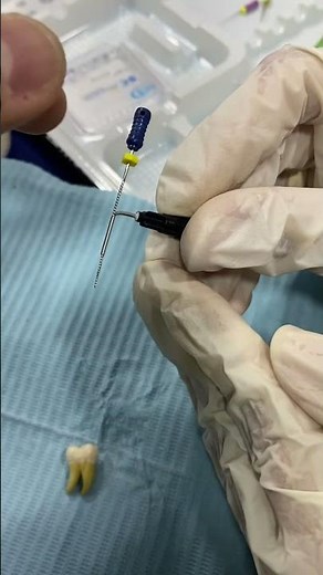 Modified Tube Technique for Broken File Removal | RCT | Root Canal Treatment | Endodontics | Complex