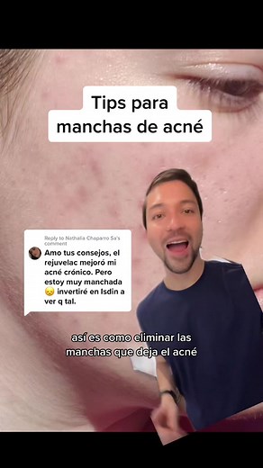 Eliminar manchas de acné rápidamente con estos tips