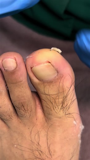 Tratamiento para Uña Encarnada en Podología