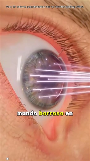 LASIK Eye Surgery (3D Animation)#lasereyesurgery #lasereyesurgeon #lasik #lasikeyesurgery #lasikeye