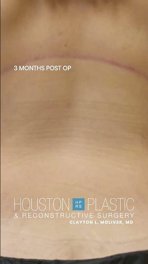 Bra line back lift 3 months post op. #saggyskin #lovehandles #plasticsurgerybeforeandafter