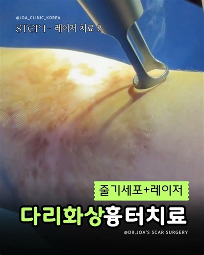 오래된 화상흉터도 줄기세포 복합치료로 #조아성형외과 #JOAPlasticSurgery
