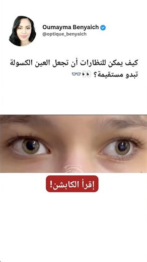 العين الكسولة!!! #eyewear #اكسبلور #ترند #عين #eyecareexcellence