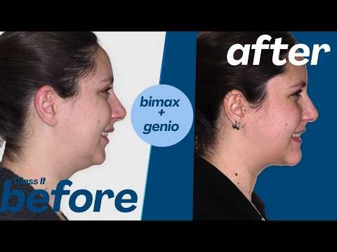 My Jaw Surgery Experience (TMJ Relief & Recovery Story)