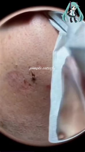 Effective Ways to Treat Acne and Pimples