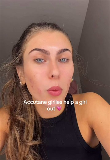 Accutane side effects and things to know before starting
