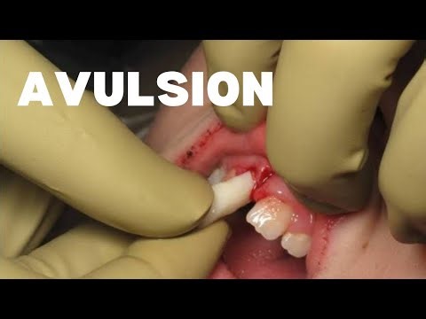 Tooth Avulsion | Storage and Management of Avulsed Teeth