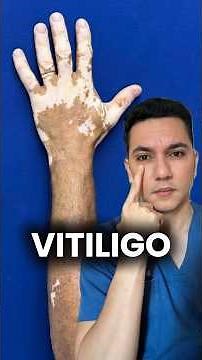 Vitiligo: when melanocytes are destroyed by the body's own immune system. #dermatology