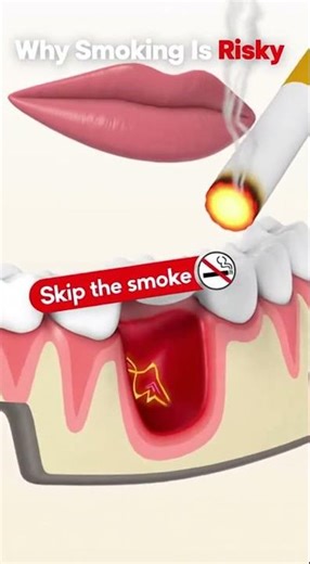 🦷 Can You Smoke After a Tooth Extraction?