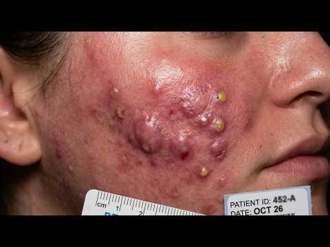 Loan Nguyen Acne Treatment 14kk