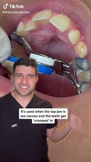 Palatal Expander: What It Is and How It Works