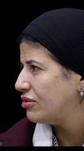 6.3K views | Before and after lip filler  Notice the subtle...