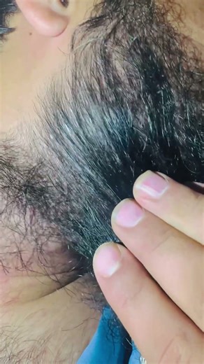 Derm reacts to ingrown hair pimple pop combo! #dermreacts #doctorreacts #pimplepop #ingrownhair