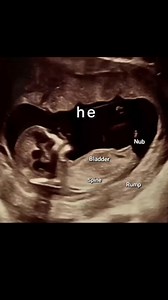 Gender reveal with nub theory! 💖 #nubtheory #babyscan #boyorgirl #genderreveal #ultrasoundscan #nubxapp #nubx | NubX: Gender Reveal & Baby Scan