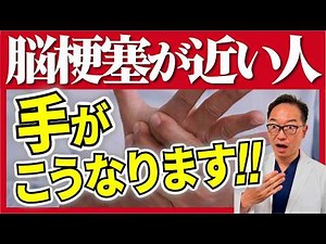 It's scary if you don't know! 5 signs of stroke that can be detected by hand signs