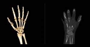 CT scan footage showing a detailed 3D rendering of a normal human hand. The scan highlights clear bone structures, joints, and soft tissues.