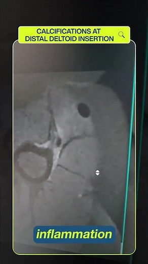 A nice case with calcifications at the distal deltoid insertion