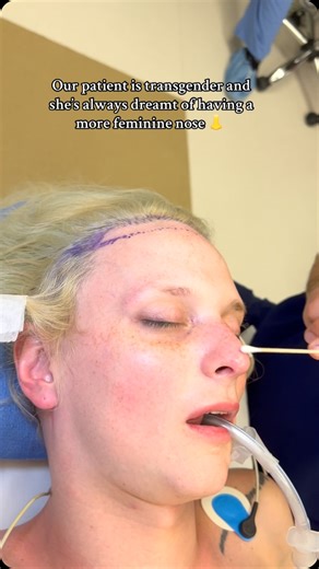 FFS Institute | Rhinoplasty is one of the key procedures we performed for Jessee as part of her facial feminization surgery. 👃 We removed the dorsal hump... | Instagram