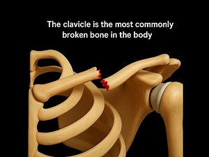 Clavicle Fracture: Symptoms, Types, Treatment, and Recovery • Video • MEDtube.net