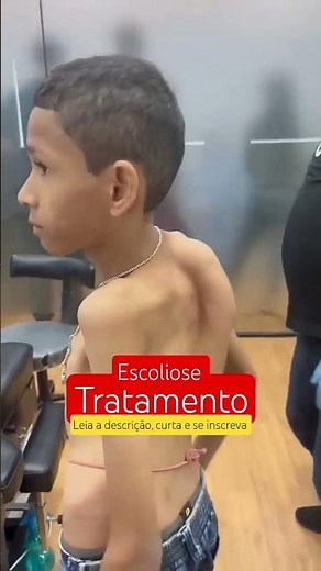 ⚠️ ESCOLIOSE: O QUE FAZER? Tratamento #ortopedia #quiropraxia #shorts