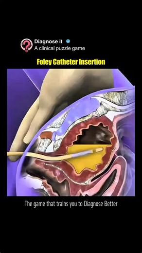 Diagnose it on Instagram: "🩺 Foley Catheter Insertion — How Urine Is Safely Drained A Foley catheter is a flexible tube inserted into the bladder through the urethra to drain urine when a patient cannot urinate normally. 🫙 Once inside the bladder, a small balloon is inflated to keep the catheter securely in place. This helps monitor urine output, relieve retention, or support patients during surgery and critical care. It’s a simple yet essential procedure that plays a big role in patient comfo