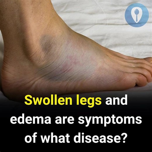 59K views · 60 reactions | Which medical conditions are linked to leg swelling and edema? | Recipes by Padma | Facebook