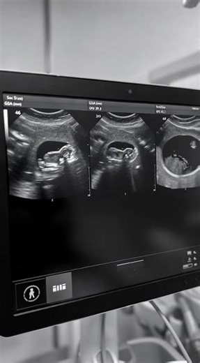 Triplets on One Ultrasound #pregnant #healtheducation