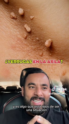 Acrocordones: ¿Qué son y por qué aparecen?