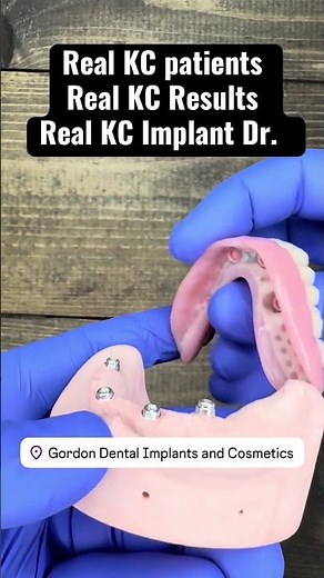 How Do Snap-On Dental Implant Dentures REALLY Work? 🔩💥 (Real Patient Results!)