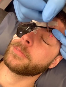 You'll be stunned by what happens when a tattoo is removed 😱 | Ultimate