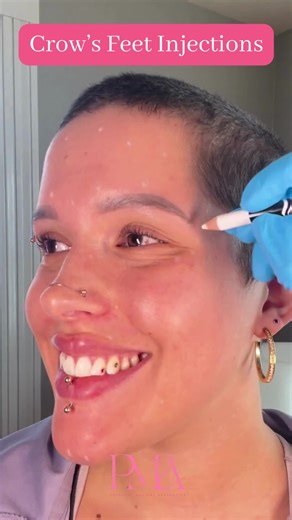 Do you or do you not get your crows feet treated when you get Botox?! It is one of the most common areas for people to omit from receiving when getting their regularly scheduled Botox injections. However, if you find that when you smile or squint and you have those fine lines and creases forming at the corners of your eyes, it may be time to start getting them treated! Book now using the link in our bio📲 • • • DM us or book online using the link in our bio! If you have any questions feel free t