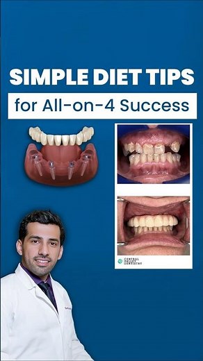 Diet Changes After All-on-4 Implants | Tips for a Smooth Recovery