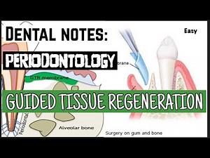 GUIDED TISSUE REGENERATION II PERIODONTAL SURGERY II PERIODONTOLOGY