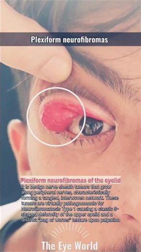 The Eye World™:Plexiform neurofibromas#eyes #ophthalmology #eyelids #youtubeshorts
