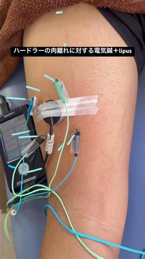 Acupuncture and electrotherapy + lipus for hamstring strain in hurdlers