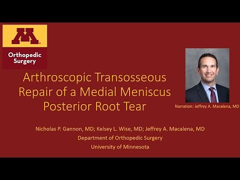 Arthroscopic Transosseous Repair of a Medial Meniscal Posterior-Root Tear: Procedure Overview