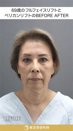 Before and after photos of a 69-year-old woman's surgical facelift and Pelican Lift.