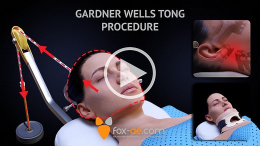 Application of Gardner Wells Tongs